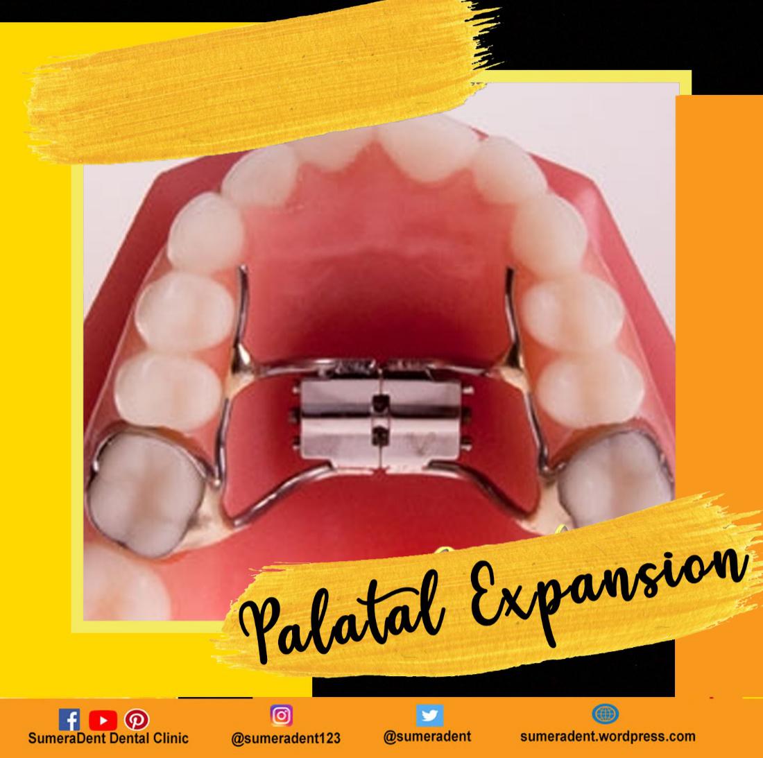 sumeradent's tweet photo. What is Palatal Expansion Appliance?
AΒ palatal expanderΒ is a device in the field of orthodontics which is used to widen theΒ upper jawΒ (maxilla) so that the bottom and upper teeth will fit together better.
#Palatal #Braces #Sumeradent #wecare https://t.co/SvBeZLiJgf