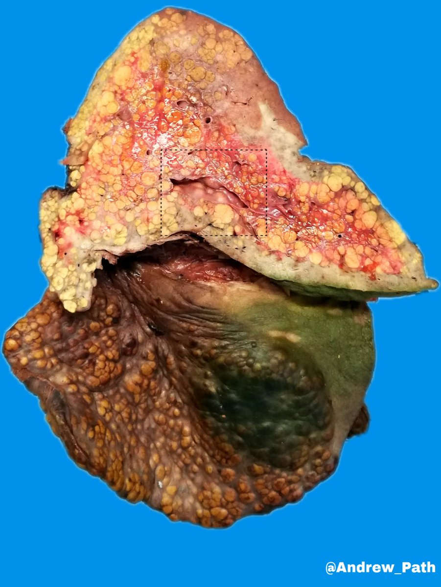 Andrew_Path's tweet photo. 1) liver of 56 y 👴🏼 (liver recipient).
📌Macronodular cirrhosis and Pressure of cirrhotic nodes on the portal vein⚡
Awesome ... 👇🏼😶
#Grossognosis #GIpath #Liverpath #pathology #Grosspath https://t.co/WQDCb1Hgnf