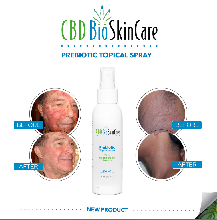 cbdforsale's tweet photo. Now Available! helps with skin issues and this spray REALLY  works! Hell, I had a big pimple starting to sprout and put a dab of CBD Oil on it and a day later it started going away, amazing right? https://t.co/ZvNqj3ITnP https://t.co/frkLNUiFxA