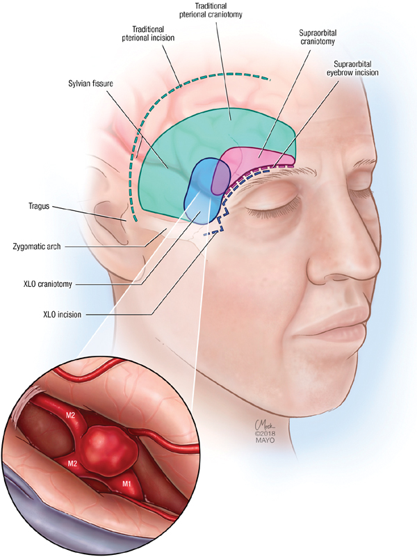 NASBSorg's tweet photo. #JNLSB_OnlineFirst
Extended Lateral Orbital Craniotomy: Anatomic Study and Initial Clinical Series of a Novel Minimally Invasive Pterional Approach https://t.co/JNXvxKWtUN #nsgy #neuroophthal #skullbase #approaches #aneurysm #braintumor https://t.co/RTvLNGJ2bd