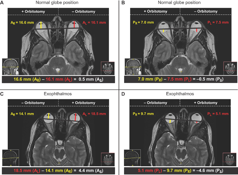 NASBSorg's tweet photo. #JNLSB_OnlineFirst
An Assessment of Globe Position Dynamics following Transcranial Lateral and Superior Orbital Wall Resections without Rigid Reconstruction
#neuroophthal #skullbase #complexcranial #approaches #hyperostosising #meningioma
https://t.co/btjLOx7KEB https://t.co/efqMHvYvyy