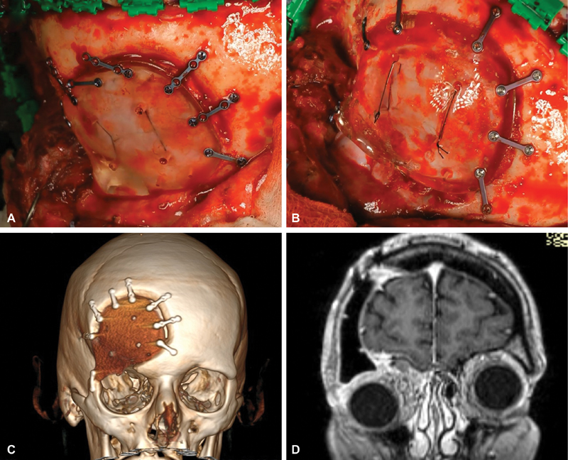NASBSorg's tweet photo. #JNLSB_OnlineFirst
Single-Step Resection of Sphenoorbital Meningiomas and Orbital Reconstruction Using Customized CAD/CAM Implants https://t.co/DAh6PtgaBv #neuroophthal #skullbase #hyperostosis #meningioma #approaches #reconstruction https://t.co/YkVjHWAodM