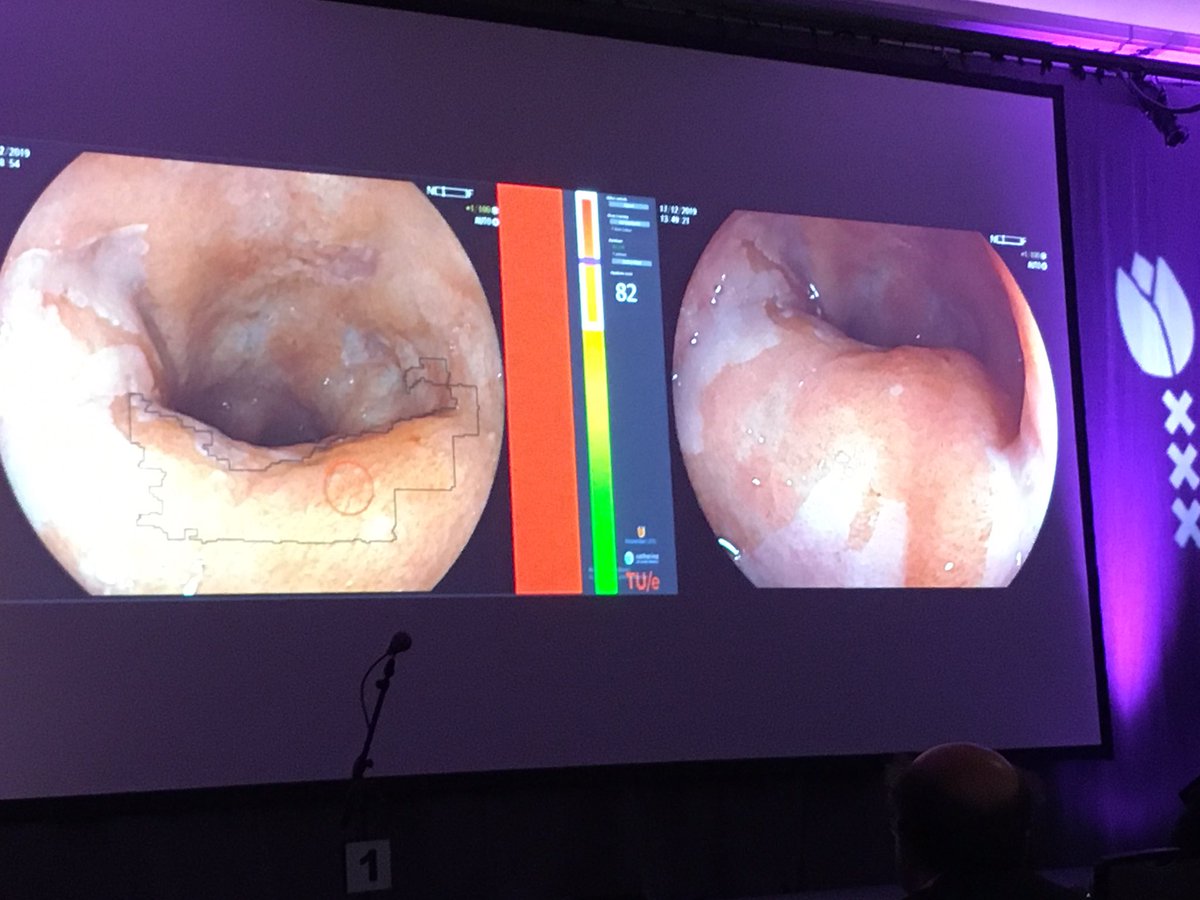 fingusmingus's tweet photo. The future is here #ALE2019 #GastroAI Barrett’s dysplasia and lesion detection https://t.co/2dP1lqK53G