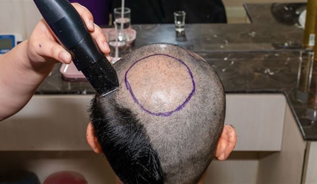 زراعة الشعر في تركيا إسطنبول