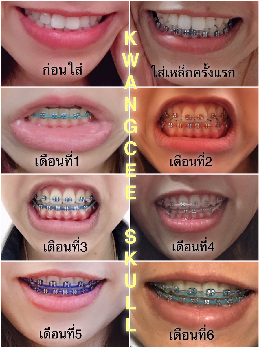ดัดฟันสีไรสวย: เคล็ดลับสำหรับการเลือกสีฟันที่เหมาะสม - Kcn Việt Phát