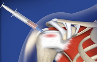 How Does Regenerative Injection Therapy Work? tinyurl.com/uguk5nq #NYCRegenerativeInjectionTherapy #PRPGraft
#TissueGraft