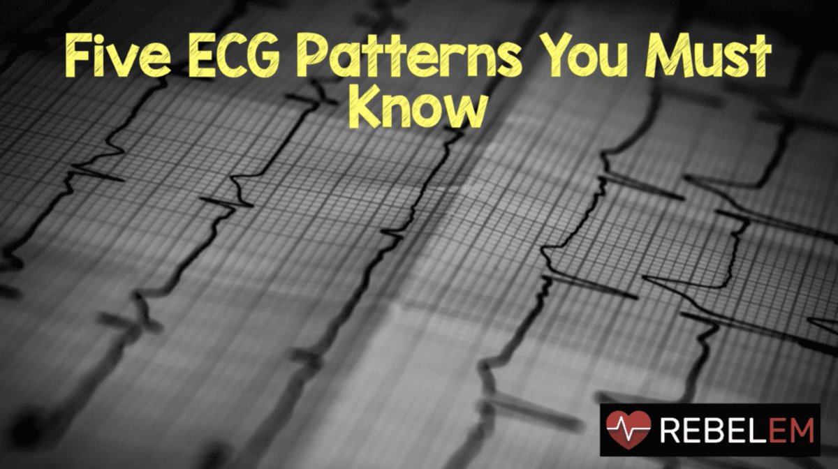 5 ECG Patterns You Must Know rebelem.com/five-ecg-patte… #FOAMed #STEMI #OMI #ECG #EKG

1st Diagonal of LAD Occlusion
De Winter's T Waves
Left Main Coronary Artery Stenosis
Wellens' Syndrome
Posterior Wall MI