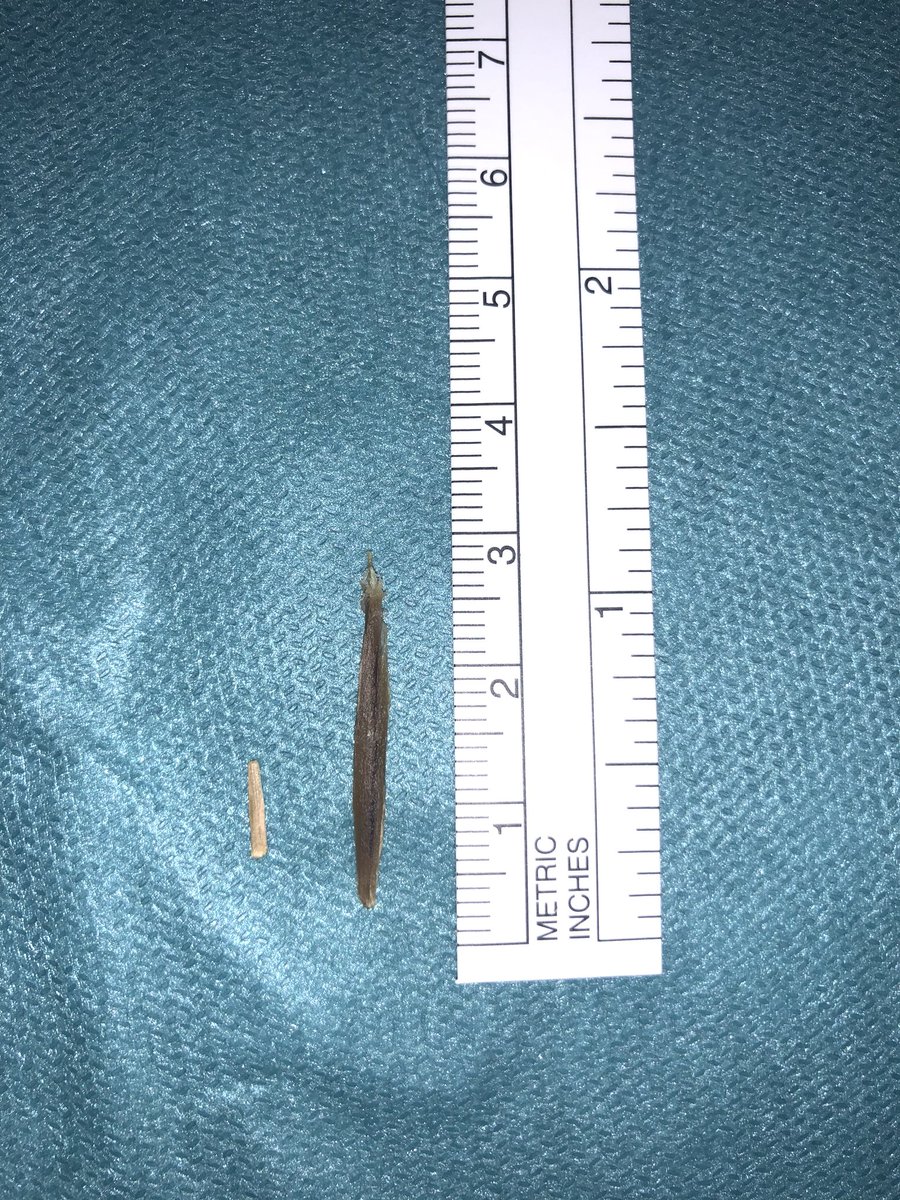 Pocas veces es tan satisfactoria una #ecografia en la consulta. El paciente refería haberse clavado una astilla en la eminencia tenar. Yo ví 2.......y las encontré 😊 #US #Eco #elecografoayudamucho