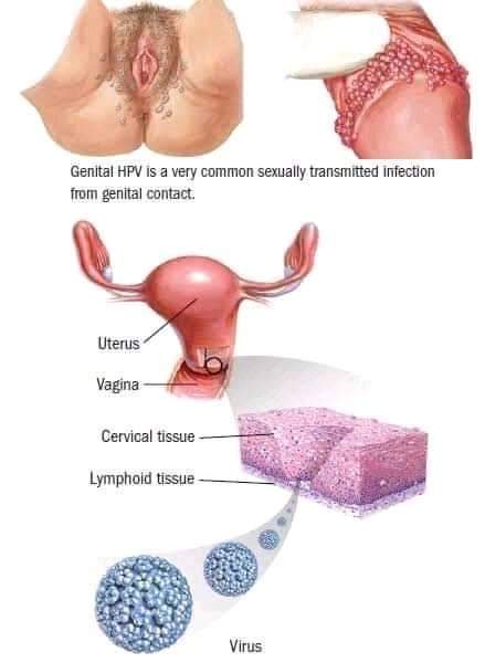 niqita11's tweet photo. For those who don't like using protection, this sti is now taking toll. Its called Human Papilloma Virus. Highly contagious and has no cure. #copied https://t.co/80cXVujIbN