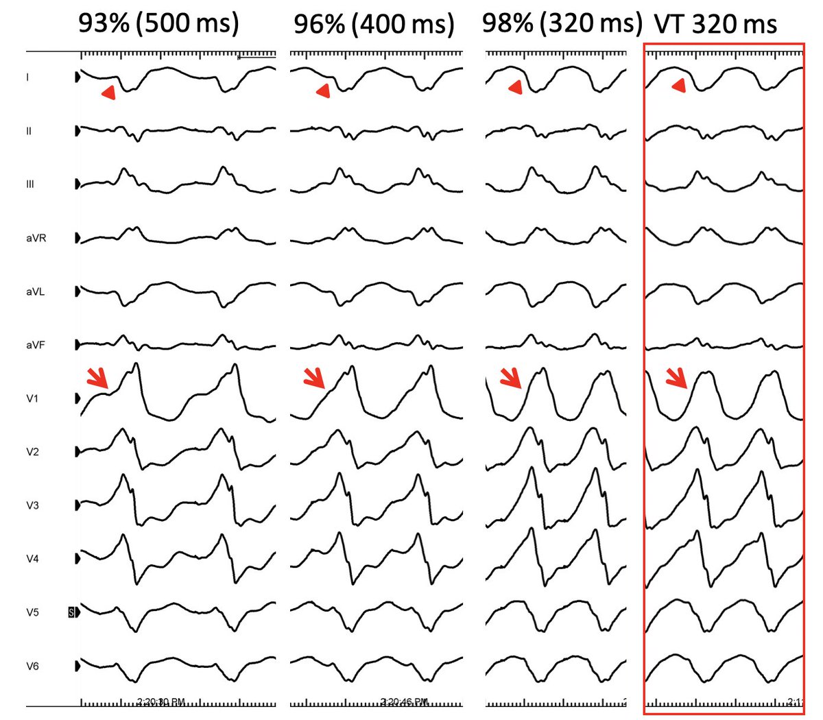 Beware: "TR fusion" phenomenon during pacemapping. Pseudo-pseudodelta waves make every site look more epicardial and hides initial R wave in lead I.  A major reason why epicardial criteria are not useful in scar-related VT. Automated scoring also changes from stable site.