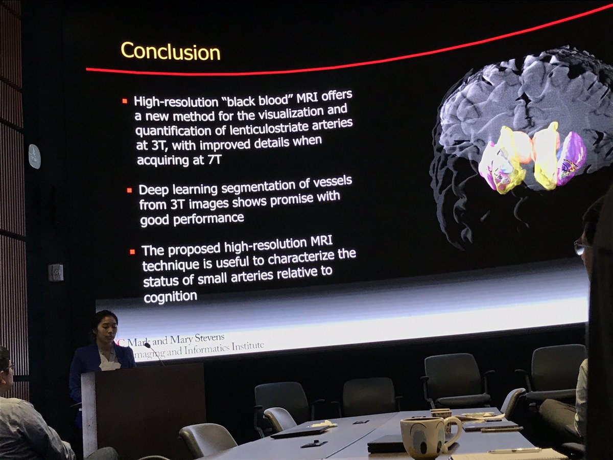 Successful #PhD #defense of Dr Samantha Ma on Imaging of #smallvesseldisease #MRI #neuroimaging #dementia #AlzheimersDisease #ultrahighfield #deeplearning #usc #uscini #uscloni