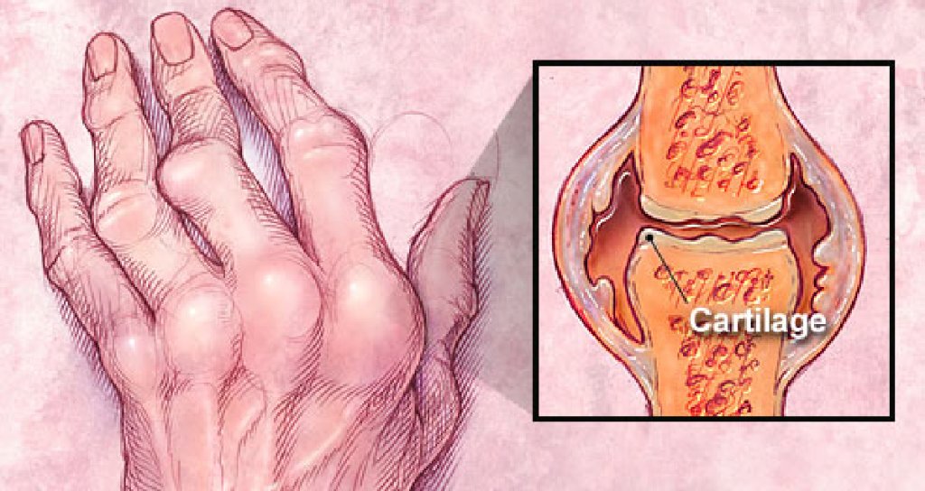 MDedge Rheumatology tweet media