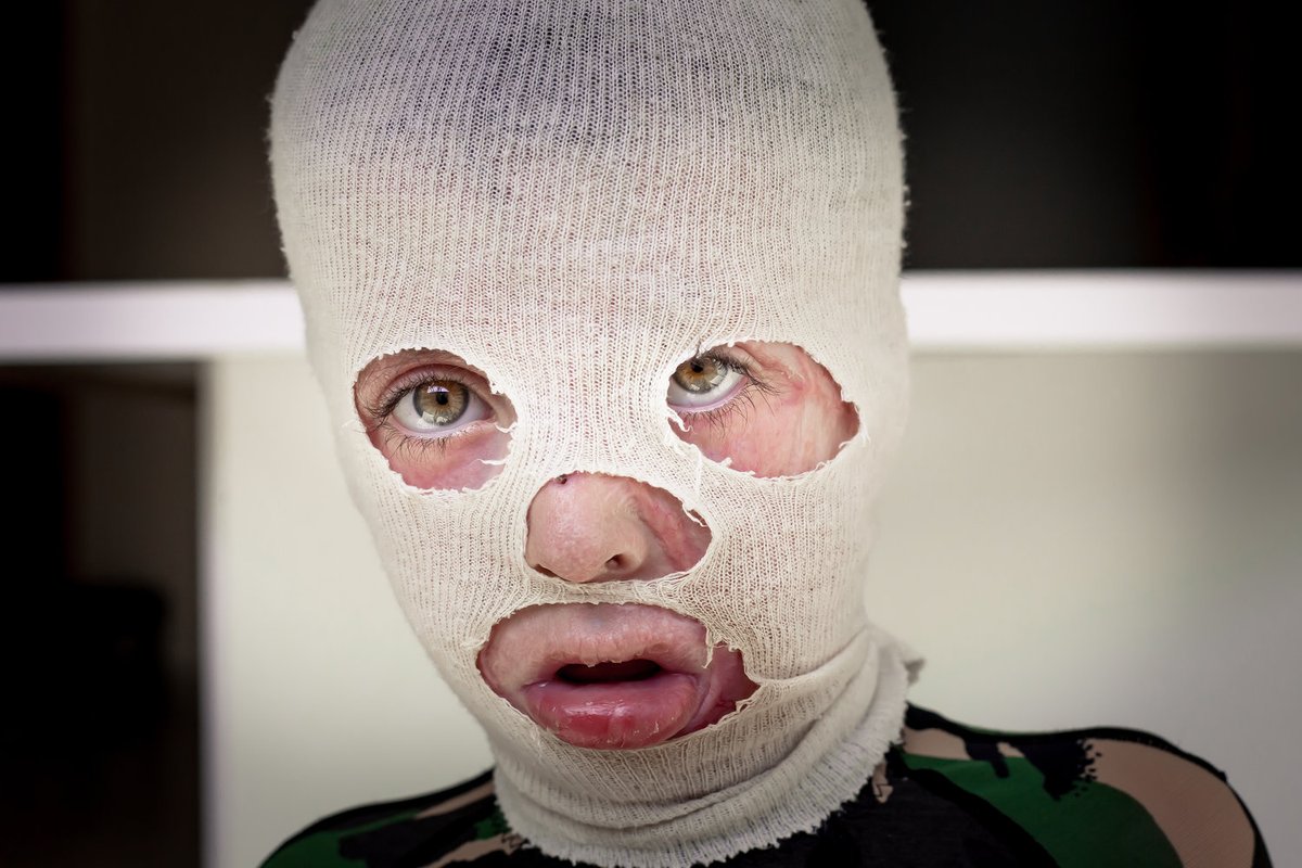 INARAorg's tweet photo. Sami was injured trying to keep warm in the room he & his family live in as refugees. The heater next to his bed set fire to his mattress, engulfing the young boy's body in flames. With winter approaching we need your donations! Every $ will be doubled! https://t.co/aJw16cwsFn https://t.co/5n0hPNn2bd