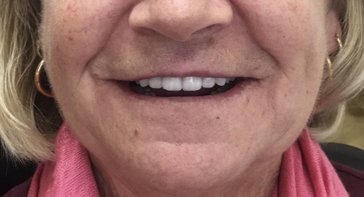 MinukSmile's tweet photo. Smile Transformation
Before & After
All on 4 upper & lower
Giving people their confidence back is what we love to do!
Call us today for your free consultation 204-589-6329
#allon4 #smile #beforeandafter #denture #dentalimplants #digitaldenture #winnipeg #winnipegsdentureclinic https://t.co/wdegUrM5oG