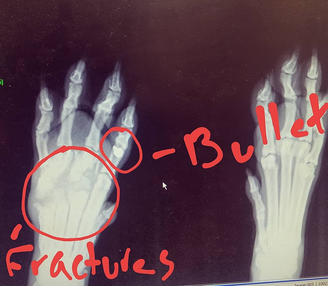 UPDATE ON #DOG #RESCUED FROM SEWER:

HE WAS SHOT IN THE PAW AND THE BULLET IS STILL THERE. 

instagram.com/p/B56mqhSlmRG/…

#GUNSHOT #DOGRESCUE #DETROIT