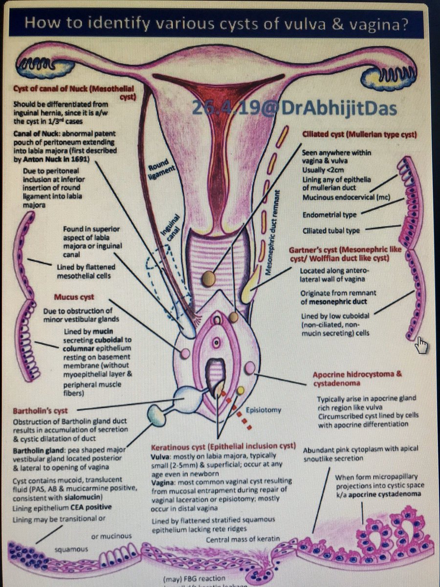 On labia majora cysts Sebaceous Cysts