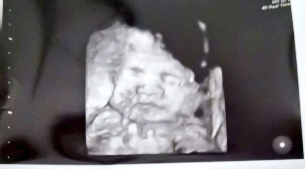 Unfruitful13's tweet photo. #28w0d Growth scan today and baby is measuring in the 80th percentile and definitely no sign of IUGR or Polyhydramnios. So happy and relieved. Cord was hiding her face so not the clearest picture 💕 #Embryo11 #IVF #ICSI #IMSI #PICSI #Infertility #ET7 #SoGrateful https://t.co/R1KMTfOy7x
