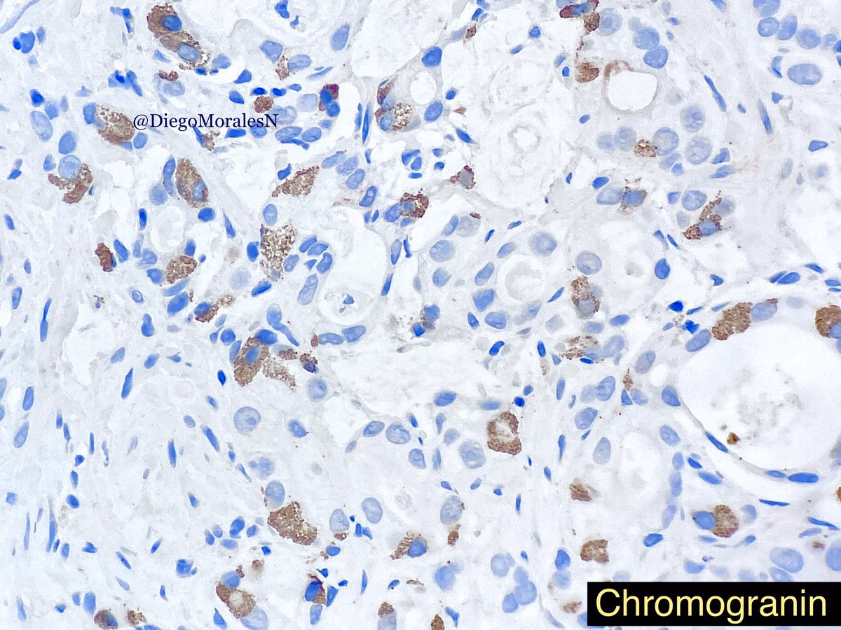 DiegoMoralesN's tweet photo. Paneth cell-like change in prostate adenocarcinoma. It constitutes neuroendocrine differenciation. Neat feature not often seen. One more case for the twitterosphere. #pathology #Gupath https://t.co/ozYi7jOvc8
