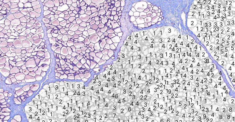 ttp_plc's tweet image. Novel #quantitativeimaging approaches will take diagnostic power to the next level while creating opportunities for automation in the multi-billion #tissuediagnostics industry. Alexander Carr reviews steps towards quantification in 2019: bit.ly/36j3sfE #thespacetoinvent