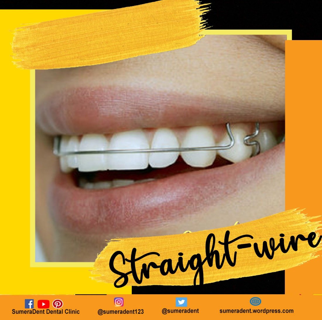 sumeradent's tweet photo. What is Straight-wire Appliance?

The standard straight-wire appliance is designed to move teeth to their desired location in the arch form. This is accomplished by using straight wire brackets in conjunction with a series of preformed arch wires.

#Sumeradent #WeCare #Dentalcare https://t.co/44ZovNZzsV