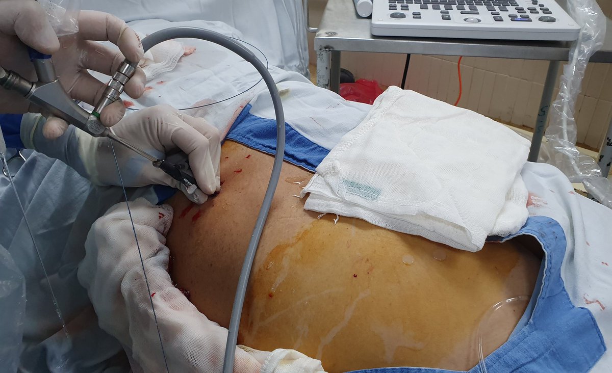 VcntKno's tweet photo. 🇲🇽Our 3rd #USGuided #Mini #PCNL w/18Fr @SeplouMedical disposable sheath. #UroSoMe
🏨 @UroMIDT1 @ozkr_tvz
@ruffoSG17 @jmsarmiento_uro
🌐 @so_uro
@CMUN_ColMexU @CAU_URO
@Uroweb @eulis_uroweb @UrowebESU @BrianHuang186 @EndoscopiaGDL @Endo_Society @jmsarmiento_uro https://t.co/8GUhmTQNG7