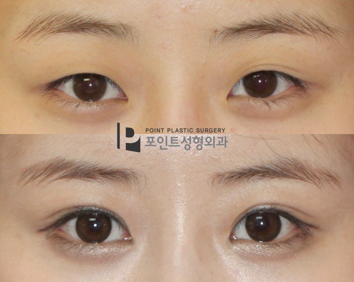 ポイント整形外科 V Twitter 症例写真より手術方法の説明に重点をおいてきましたが 症例を見たいとの方の為にこれからは上々にアップしてみます ナチュラルな二重が希望だった患者さま 非切開目つき矯正で左右非対称を矯正し 目尻に向けて広がる二重に仕上げ