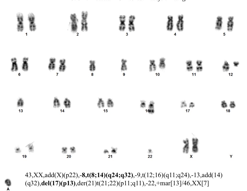 gretnhe's tweet photo. Agressive B-cell lymphoma with a complex karyotype, t(8;14) and TP53 deletion. MYC-IGH rearrangement was confirmed by FISH with Tri-color probe that helps to identify breakpoint near to MYC gene. #variantFISHpatterns #FISH #MYC https://t.co/Em2l6vpnuu