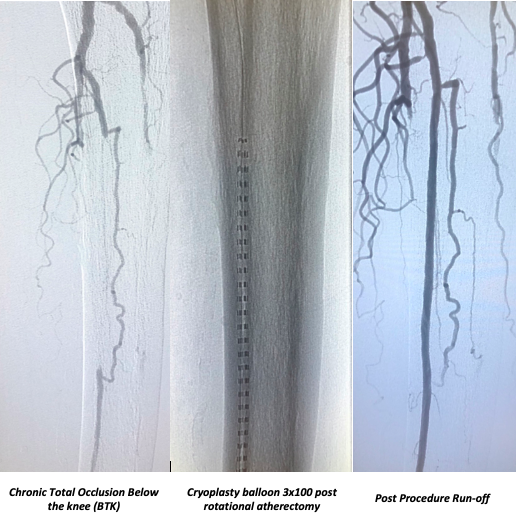 nucryo's tweet photo. Excellent critical limb ischemia case today with PolarCath!   Chronic total occlusion (CTO) below-the-knee (BTK) case completed with rotational atherectomy from @csi360  followed by a 3x100 PolarCath balloon (Cryoplasty) @nucryo   #outcomes #results #patient #indications https://t.co/rZNnc5WmuQ