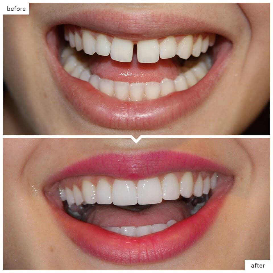 ISmileCenter's tweet photo. Veneers transform smiles and increase confidence. SMILE BIG! 
#veneers #drfelli #smilemakeover #infinitysmilecenter #dentistry https://t.co/HPd8DQCCtP