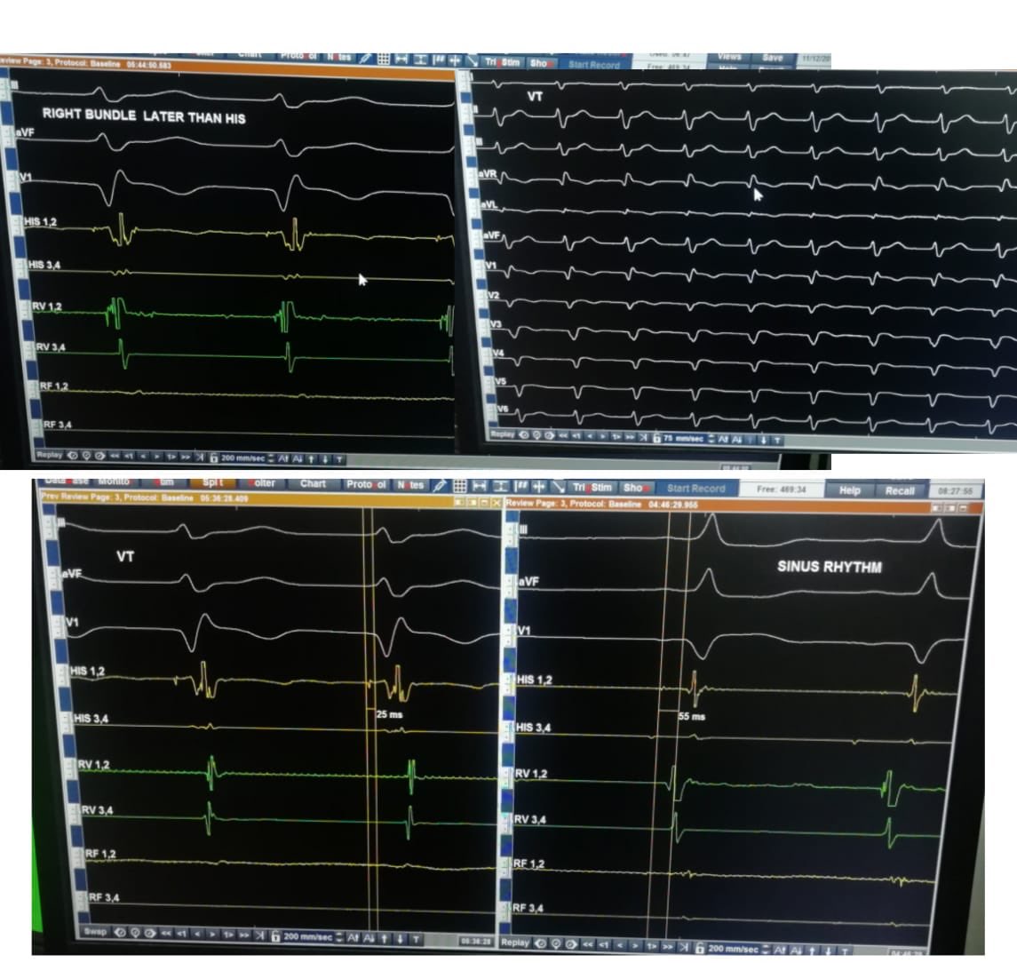 UlhasDr's tweet photo. Post-MI, Mid-septal scar VT, engaging conduction system. @mmm_ep @gauravaupadhyay @VTholakanahalli @JICE_EP @SchakrabartiEP @BrugadaAblation @DCR_Dr @manak_18 @drnjy @DrAvinashVerma5 @BadhwarNitish @KakkamKrishna https://t.co/2WqXRR8xMd