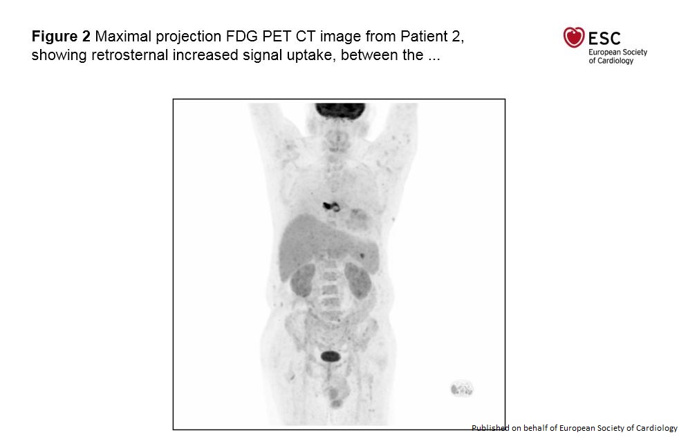 ESC_Journals's tweet photo. Would you use pursue FDG PET-CT scanning for suspected prosthetic valve endocarditis with negative cultures, TTE and TEE? https://t.co/27zsZUcgHN

 @johncamm @escardio #echofirst #openaccess #EHJCaseReports #ESCCoT #ESCardioEd #CardioTwitter #MedTwitter https://t.co/rmlYq64MV9