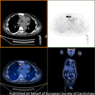 Would you use pursue FDG PET-CT scanning for suspected prosthetic valve endocarditis with negative cultures, TTE and TEE? bit.ly/38pxdxc

 <a href="/johncamm/">Mohammed Ali</a> <a href="/escardio/">European Society of Cardiology</a> #echofirst #openaccess #EHJCaseReports #ESCCoT #ESCardioEd #CardioTwitter #MedTwitter