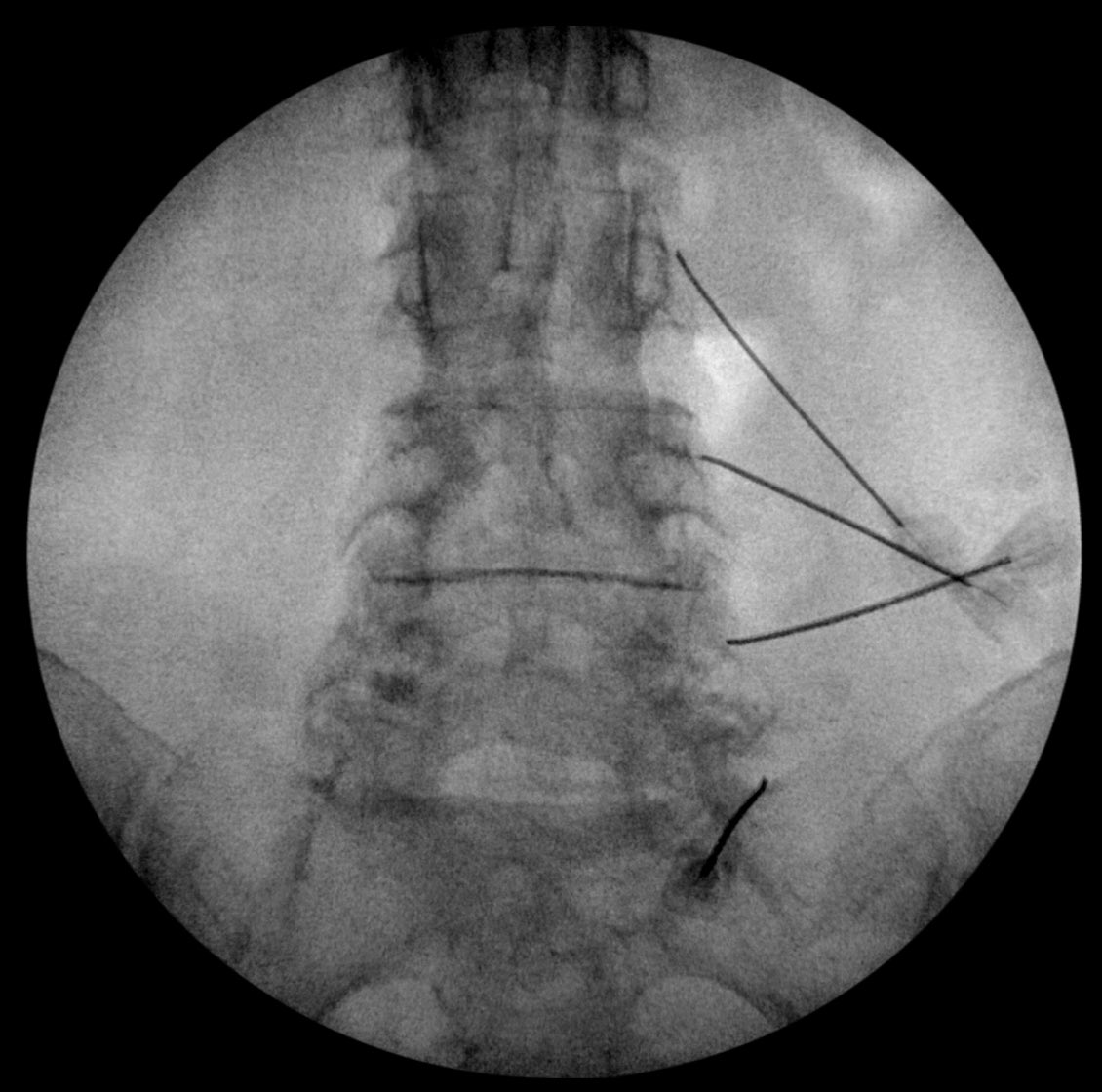 InjxGPO's tweet photo. We were able to save one practice over 25% off of their RF needles!! That’s huge!! Contact us today to find out how you can too! #whypaymore #PowerofaGPO #medtwitter #INJXisaGPO https://t.co/5a9x4weurG