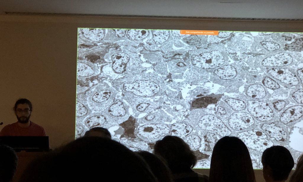 lara_pijuan's tweet image. Segon Cas pel Dr.Adrian Puche de l’ @hospitaldelmar. Gràcies a l’estudi molecular (FISH SYT by @marta_msalido) es va diagnosticar bé un Sarcoma Sinovial Pobrement Diferenciat però també ensenya imatges de citologia i microscopia electrònica 🤩 #SCAP2020 #HdMPathologist #pulmpath