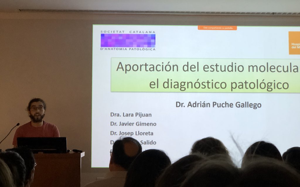 lara_pijuan's tweet image. Segon Cas pel Dr.Adrian Puche de l’ @hospitaldelmar. Gràcies a l’estudi molecular (FISH SYT by @marta_msalido) es va diagnosticar bé un Sarcoma Sinovial Pobrement Diferenciat però també ensenya imatges de citologia i microscopia electrònica 🤩 #SCAP2020 #HdMPathologist #pulmpath