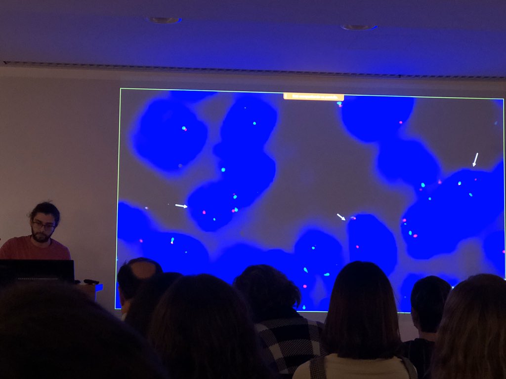 lara_pijuan's tweet image. Segon Cas pel Dr.Adrian Puche de l’ @hospitaldelmar. Gràcies a l’estudi molecular (FISH SYT by @marta_msalido) es va diagnosticar bé un Sarcoma Sinovial Pobrement Diferenciat però també ensenya imatges de citologia i microscopia electrònica 🤩 #SCAP2020 #HdMPathologist #pulmpath