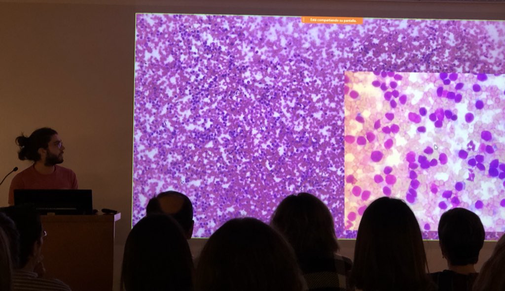 lara_pijuan's tweet image. Segon Cas pel Dr.Adrian Puche de l’ @hospitaldelmar. Gràcies a l’estudi molecular (FISH SYT by @marta_msalido) es va diagnosticar bé un Sarcoma Sinovial Pobrement Diferenciat però també ensenya imatges de citologia i microscopia electrònica 🤩 #SCAP2020 #HdMPathologist #pulmpath