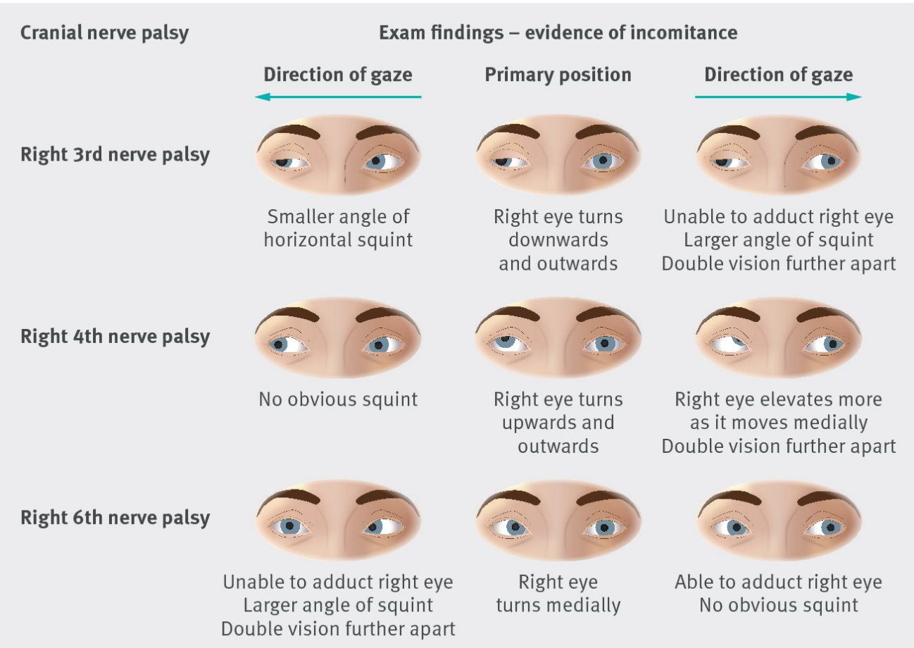 Cranial Nerve 3 Palsy