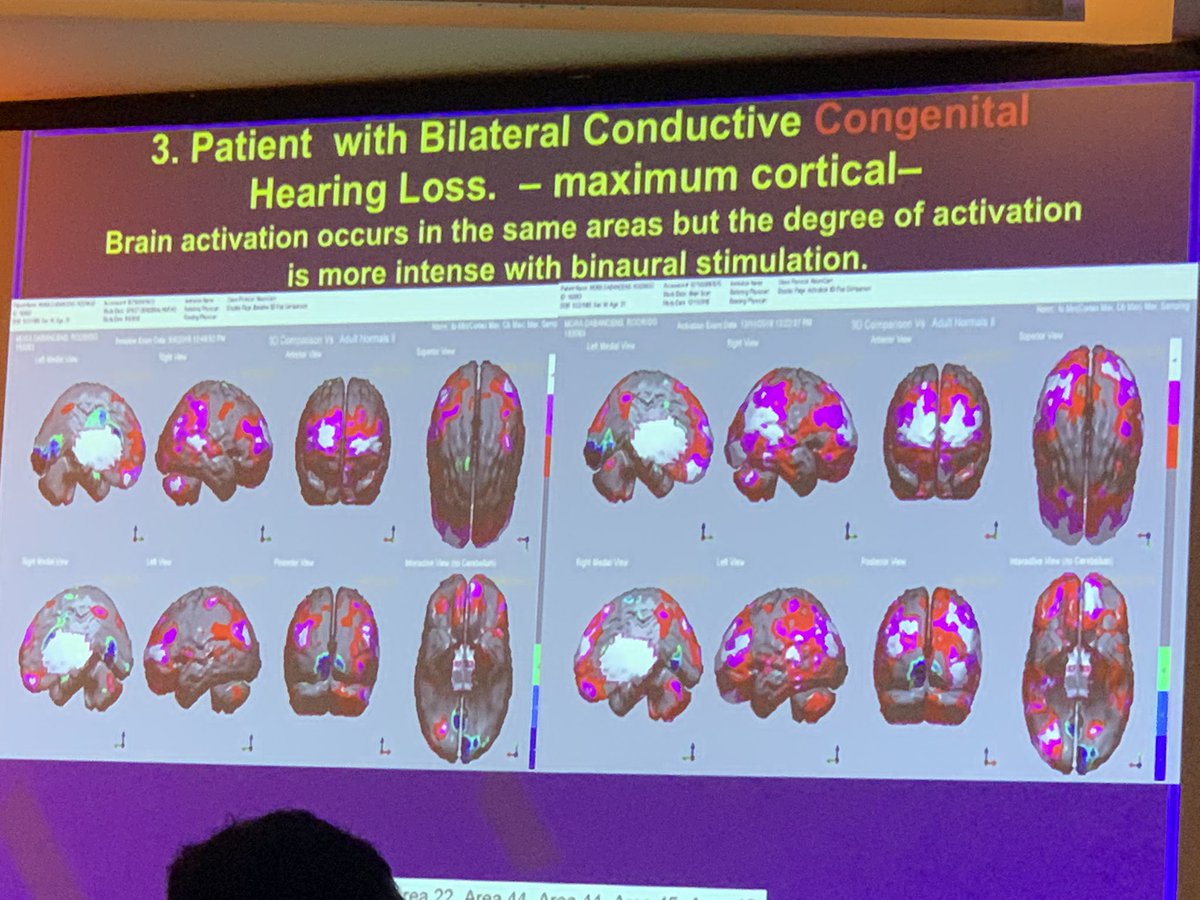 meredith_berger's tweet photo. Marcos Goycoolea shared from his study suggesting unilateral input for a bilateral conductive loss results in cortical deprivation due to lack of stimulation. #osseo2019 #2Ears2Aids https://t.co/xRnYvSCn3N