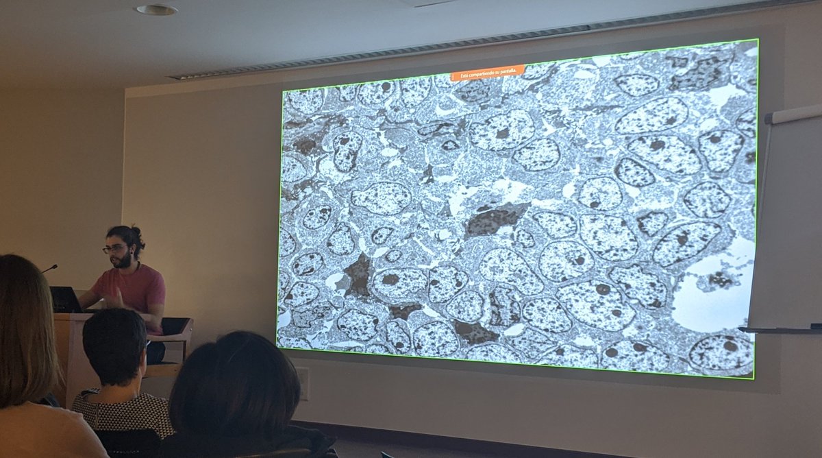 SCAPSoMe's tweet image. El Dr Adrián Puche ens ha presentat un cas molt ben ilustrat: sarcoma sinovial pobrement diferenciat #scap2020