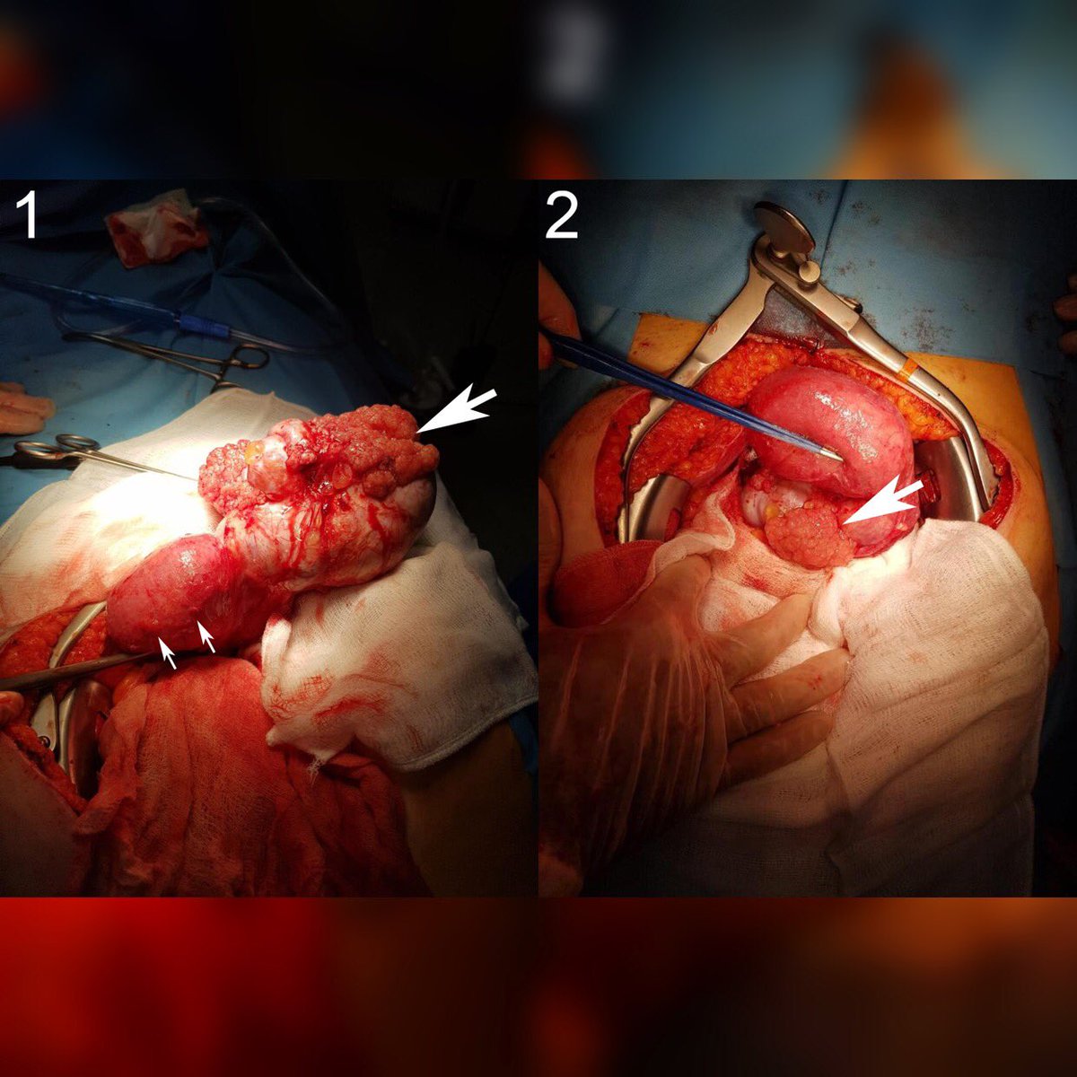 database_image's tweet photo. 📸 Macroscopic diagnosis of an ovarian adenocarcinoma with peritoneal metastasis and intestinal obstruction

#ovarianadenocarcinoma #macroscopicdiagnosis

🔎 https://t.co/TAD5xN3QKh https://t.co/3Oplhak1Oo