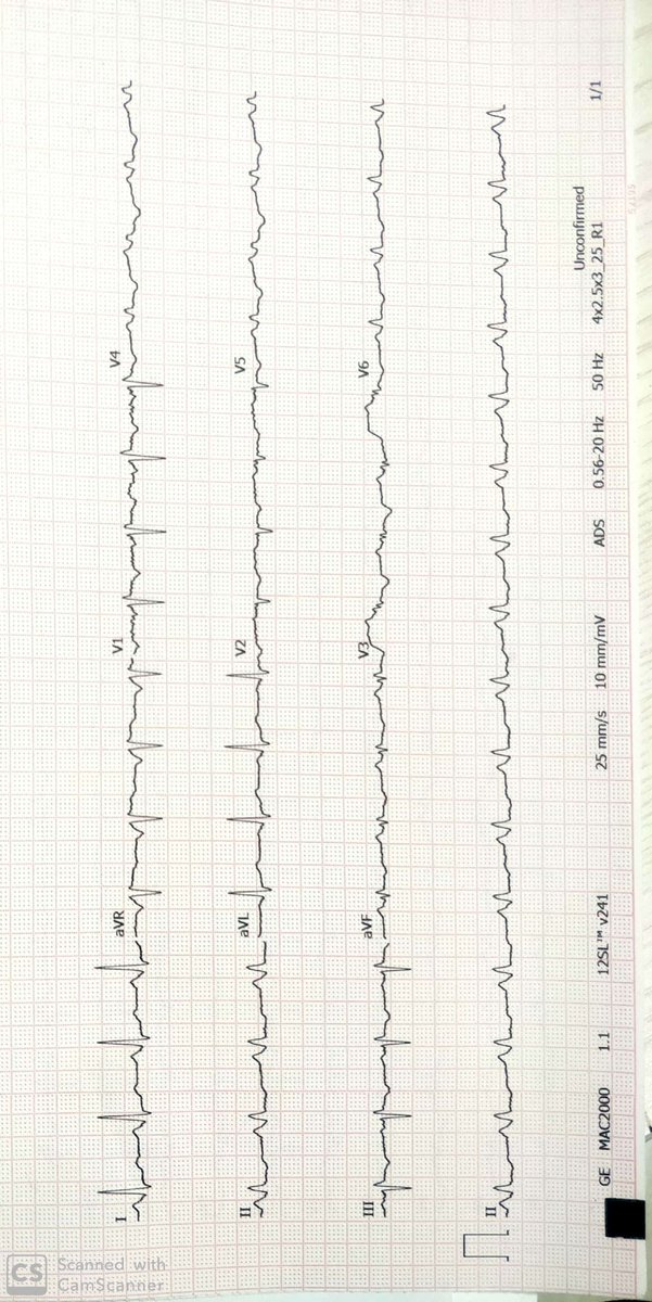 #pacenaturally  Middle aged female with highly symptomatic AV block. LBB Pacing done
Paced QRS is 108 msec. Nice Qr in V1
Stable threshold of 0.6v 
<a href="/psharmadoc/">Parikshit S Sharma, MD, MPH, FACC, FHRS</a> 
 
<a href="/Hisdoc1/">Pugal Vijayaraman</a>
 
<a href="/MdHuang/">Weijian Huang</a>
 
@gopi_gdanda1
 
<a href="/gauravaupadhyay/">Gaurav A. Upadhyay</a>
