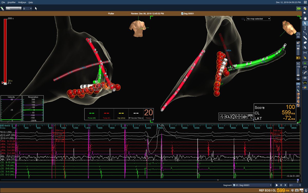 MicheleB_MD's tweet image. This is how long fellow Max took to get termination of #typicalflutter with the first lesion: a bit more than 1s. Record ablation difficult to beat! 50min procedural time including 20min waiting after BidBlock. 338s of RF. #nofluoro #noice #KMD #ensite #alcathflutterflux #EPeeps
