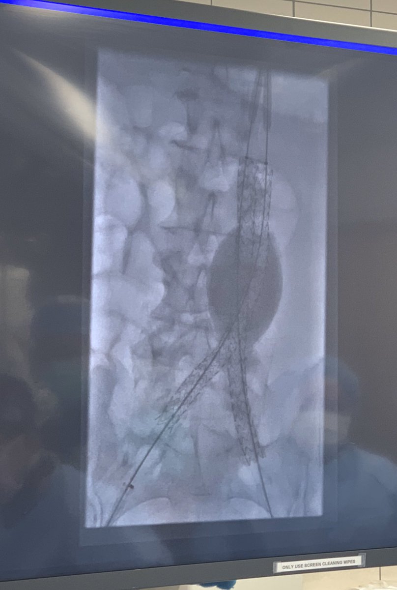 Vernon_HorstMD's tweet photo. AAA Repair With #NELLIX Device, with polymer filling the aneurysm sac. #Betterseal #NoEndoLeak #Endologix #EVAS2 #ComprehensiveVascularCare @prn19 @VirajPandit @OUVascular https://t.co/50bzX3kuj5