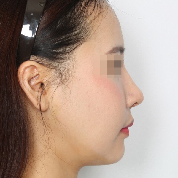 Facedesign 脂肪吸引 頬骨 ナチュラルで可愛い小顔 輪郭3点 輪郭 無顎 頬骨 下顎 両顎 セットバック エラ削り 出っ歯 口ゴボ 3d顔面 噛み合わせ しゃくれ顎 うけくち オルチャン ソウル 韓国 東京 エラ削り 歯茎