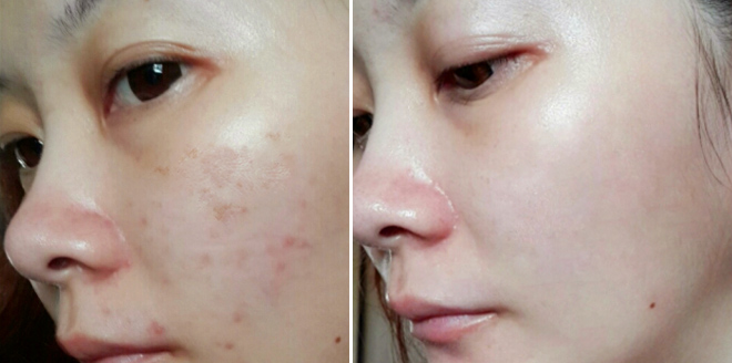 Maeko 美容ブログ運営 Auf Twitter シミ仲間に クロノセル おすすめしたら まさかのキャンペーン終了やったらしい クロノセル はまじでシミ消えるし みんなも1回は試してほしい 私が使ったときの写真晒しときますね 2週間でこうなった クロノセル