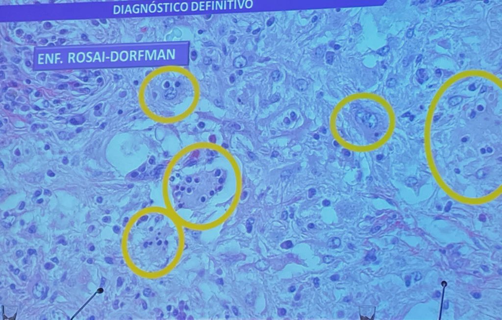 tlabiano's tweet photo. Dr. Erika Iglesias de HU Araba presenta un caso de Enf de Rosai-Dorfmann en pelvis renal #RegionalNorte168 en #Pamplona @SEAP_IAP https://t.co/HocPFYCS3u