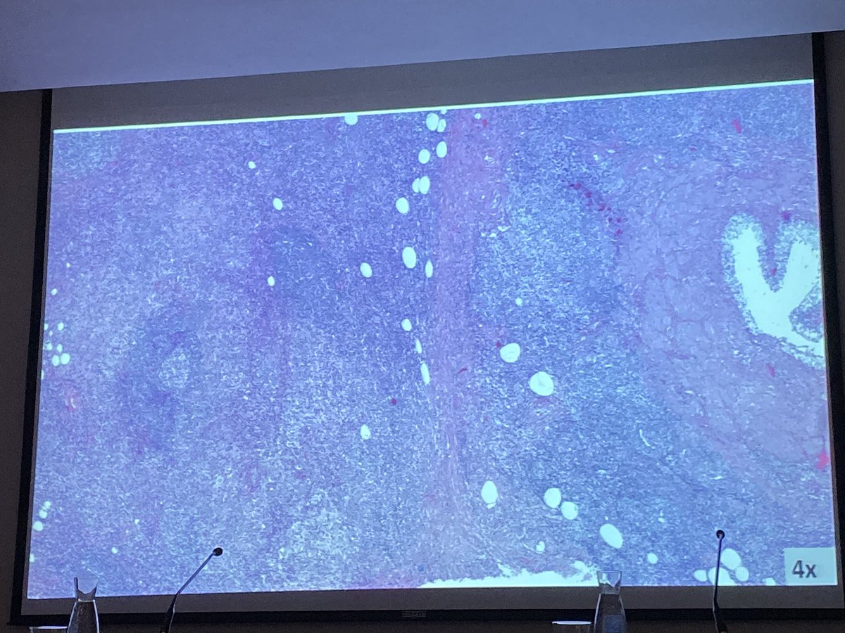 tlabiano's tweet photo. Dr. Erika Iglesias de HU Araba presenta un caso de Enf de Rosai-Dorfmann en pelvis renal #RegionalNorte168 en #Pamplona @SEAP_IAP https://t.co/HocPFYCS3u