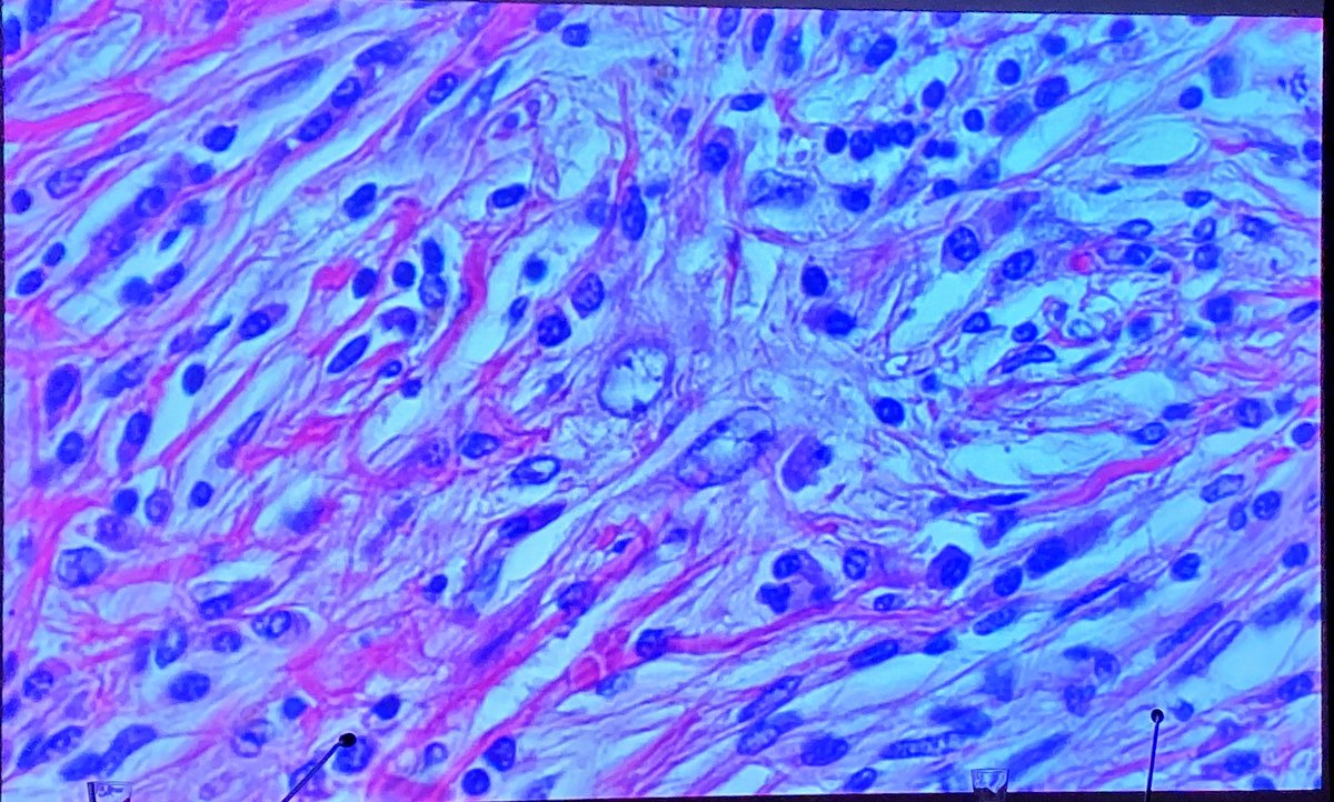 tlabiano's tweet photo. Dr. Erika Iglesias de HU Araba presenta un caso de Enf de Rosai-Dorfmann en pelvis renal #RegionalNorte168 en #Pamplona @SEAP_IAP https://t.co/HocPFYCS3u