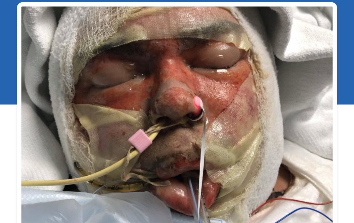 Marriedasfuck's tweet photo. This is Griffins friend and teammate James! Every dollar helps to get him functioning hands. Please share and donate if you can! @Jodieb501 @manbrain69 @ChadFackler1 @JenFackler @thatsnotproper @mediaforestcast @DrMuddington @MillerRachelD @amylyle https://t.co/f0vzVt0Fhf https://t.co/Lh2t7d4Aqw